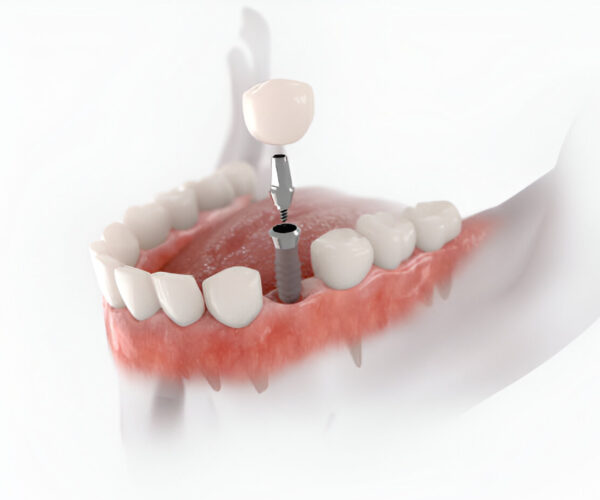 dental implants near you at key dental clinic