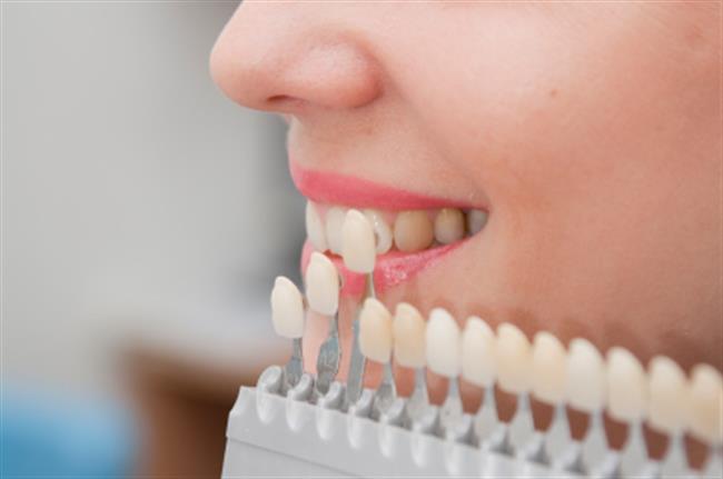 dental veneers at key dental clinic