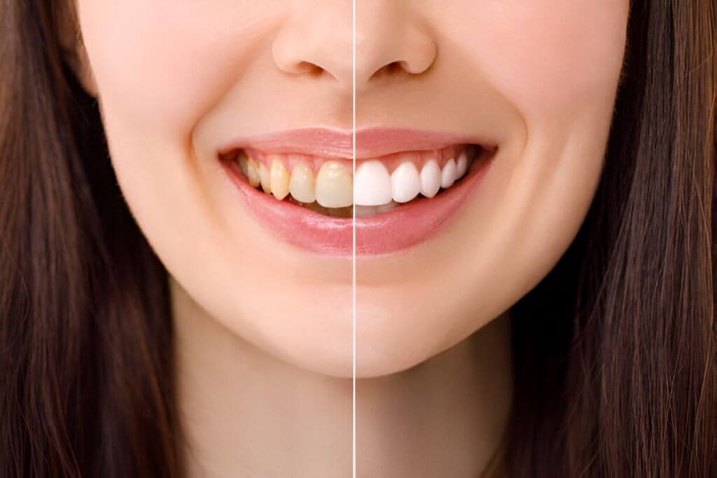 teeth whitening near you